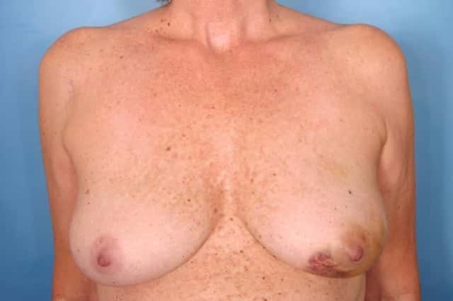 Breast Reconstruction Before & After Case 63 before