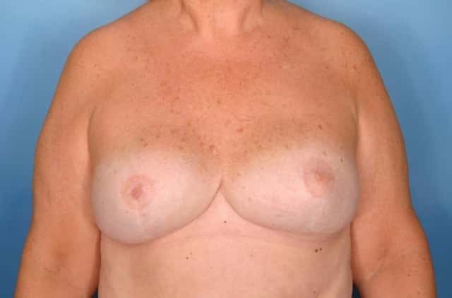 Breast Reconstruction Before & After Case 85 after