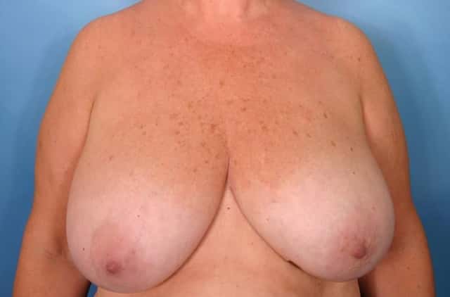 Breast Reconstruction Before & After Case 85 before