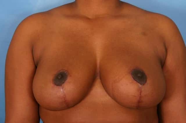 Breast Reduction Before & After Case 33 after