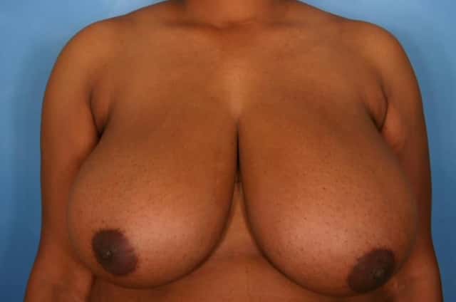 Breast Reduction Before & After Case 33 before