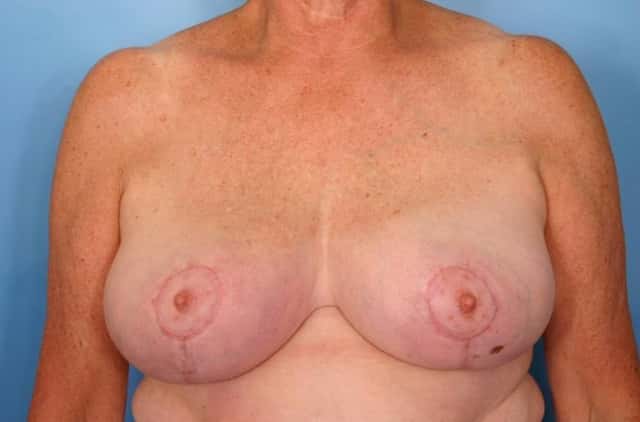 Breast Reduction Before & After Case 59 after