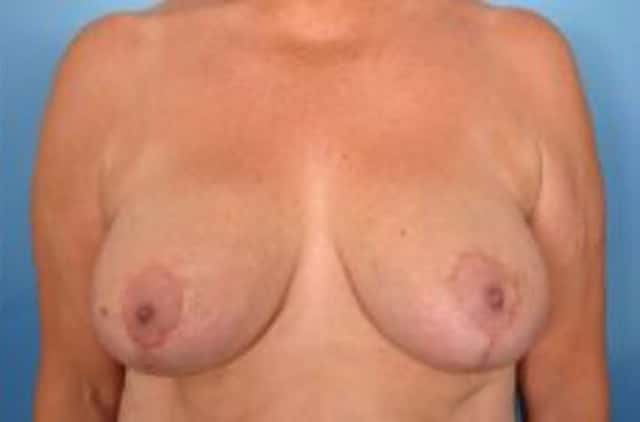 Breast Reduction Before & After Case 7 after