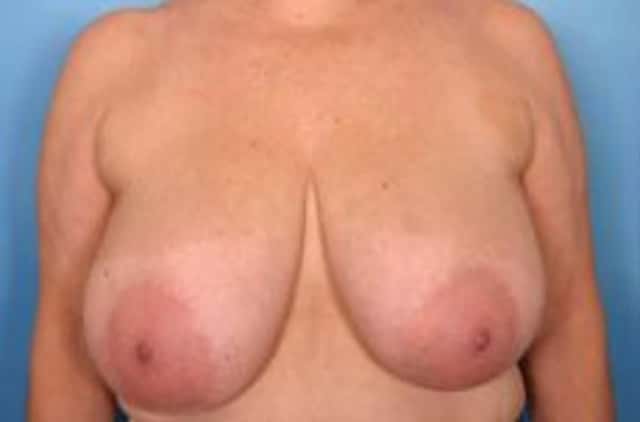 Breast Reduction Before & After Case 7 before