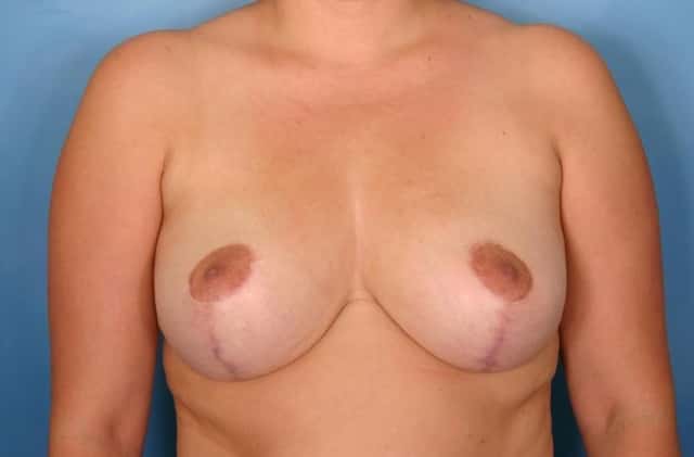 Breast Reduction Before & After Case 83 after