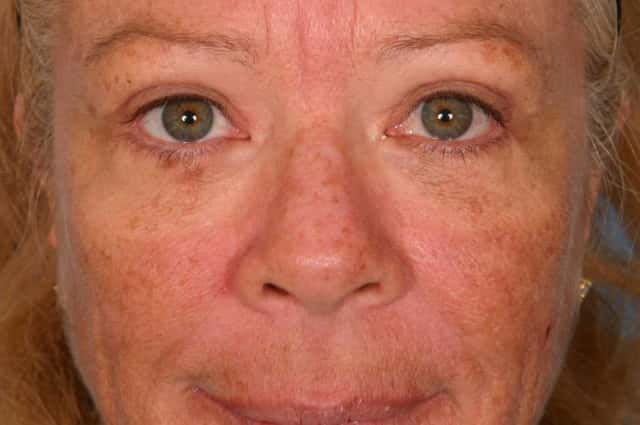 Brow Lift Before & After Case 54 after