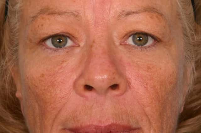 Brow Lift Before & After Case 54 before