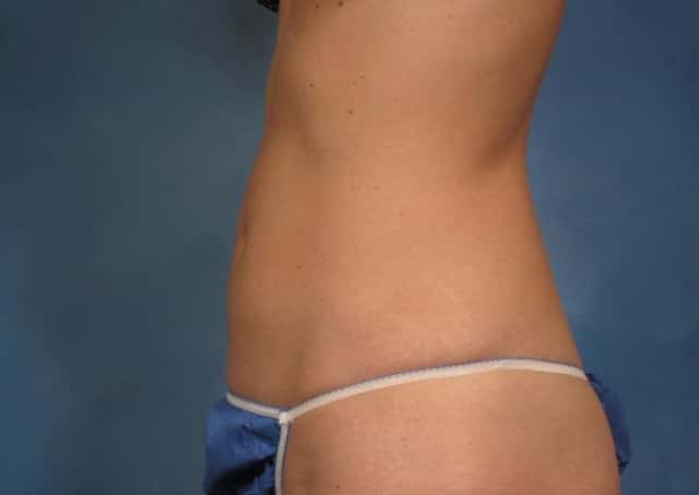 CoolSculpting® Elite Before & After Case 139 after