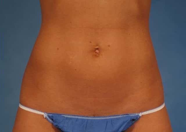 CoolSculpting Elite Before & After Case 146 after