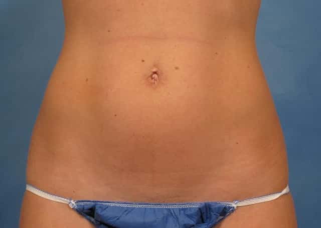 CoolSculpting Elite Before & After Case 146 before