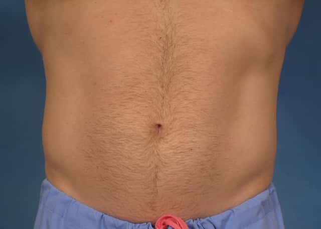 CoolSculpting Elite Before & After Case 153 after