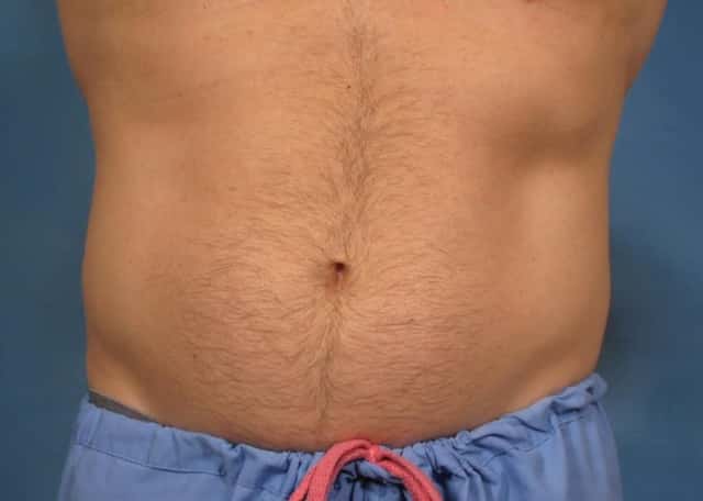 CoolSculpting Elite Before & After Case 153 before