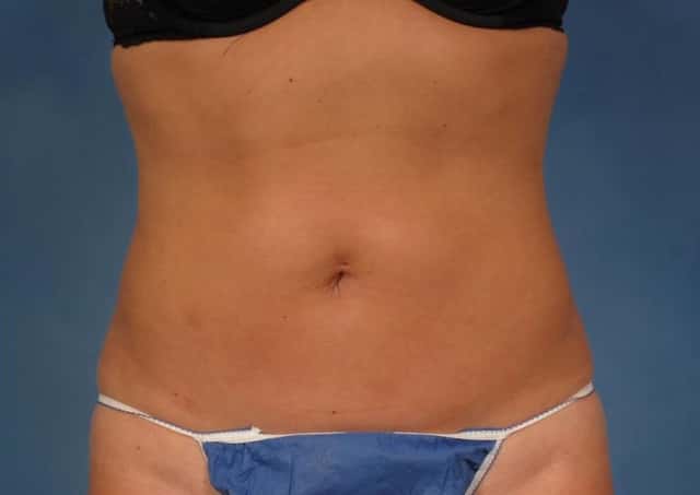 CoolSculpting Elite Before & After Case 154 after