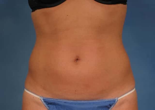 CoolSculpting Elite Before & After Case 154 before