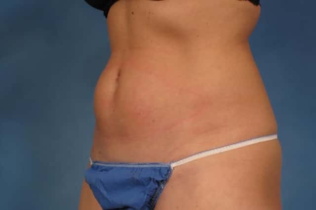 CoolSculpting Elite Before & After Case 155 before