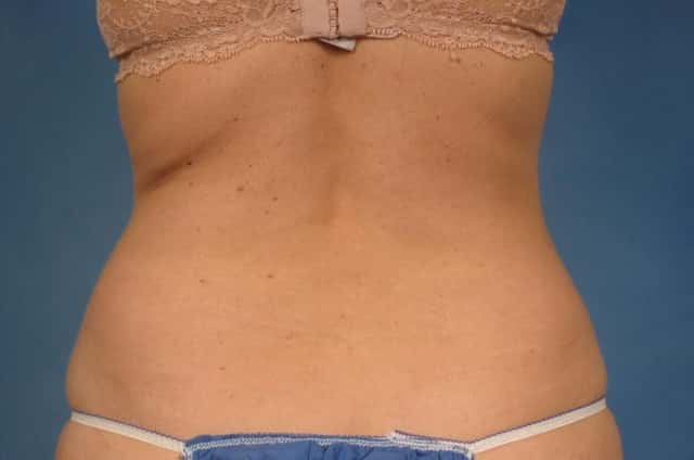 CoolSculpting Elite Before & After Case 164 after