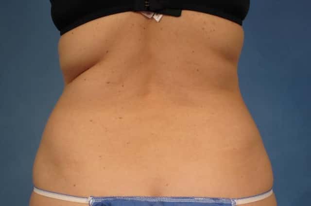 CoolSculpting Elite Before & After Case 164 before