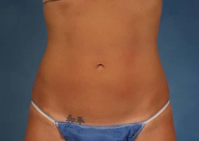 CoolSculpting® Elite Before & After Case 167 after