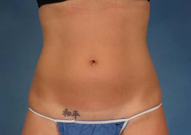 CoolSculpting® Elite Before & After Case 167 before