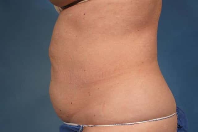 CoolSculpting Elite Before & After Case 190 after