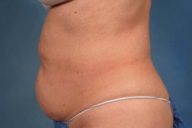 CoolSculpting Elite Before & After Case 190 before