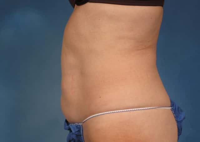 CoolSculpting® Elite Before & After Case 195 after