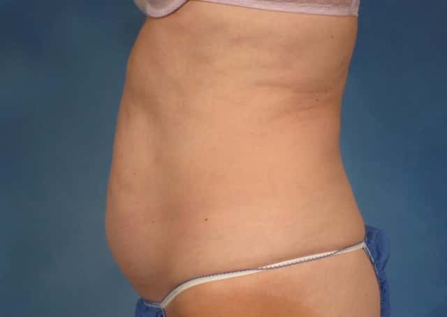 CoolSculpting® Elite Before & After Case 195 before