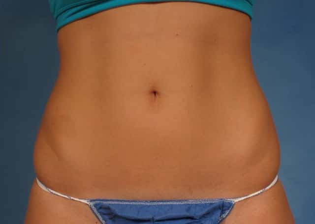 CoolSculpting Elite Before & After Case 198 after