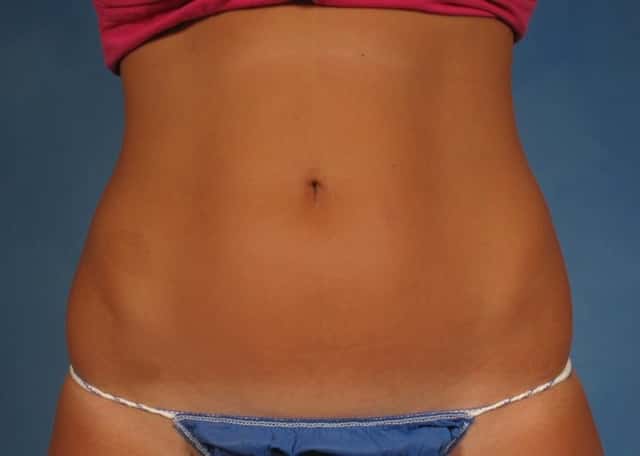 CoolSculpting Elite Before & After Case 198 before