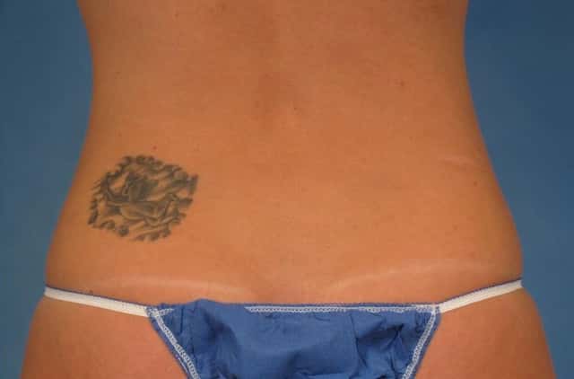 CoolSculpting® Elite Before & After Case 210 after