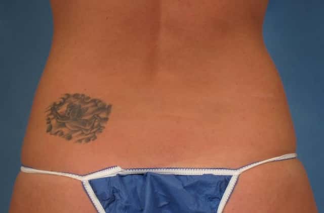 CoolSculpting® Elite Before & After Case 210 before