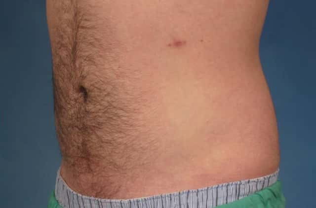 CoolSculpting Elite Before & After Case 211 after