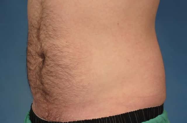 CoolSculpting Elite Before & After Case 211 before