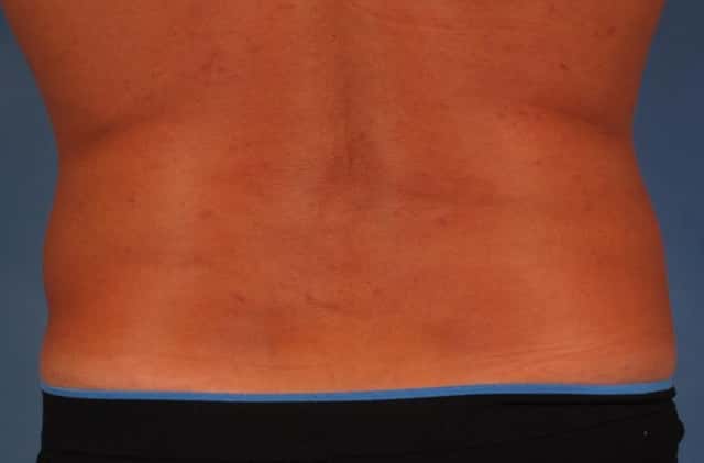 CoolSculpting Elite Before & After Case 212 after