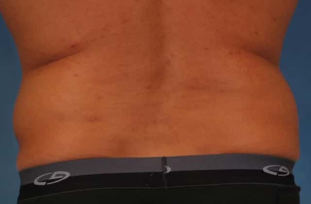 CoolSculpting Elite Before & After Case 212 before