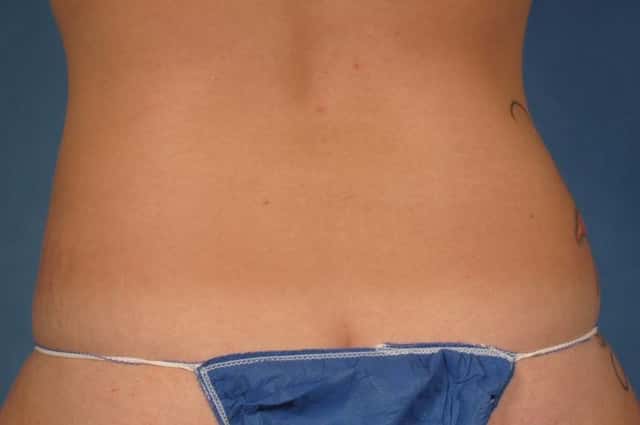CoolSculpting® Elite Before & After Case 214 after
