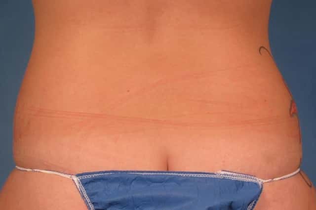 CoolSculpting® Elite Before & After Case 214 before