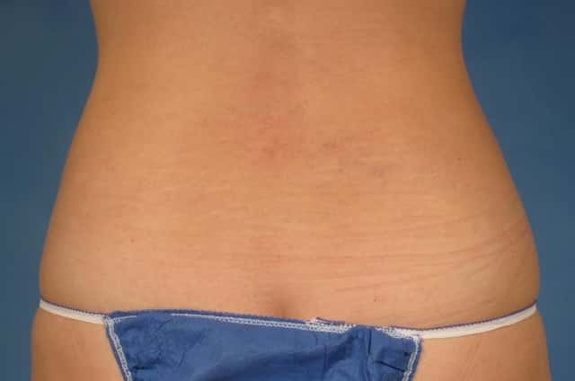 CoolSculpting Elite Before & After Case 215 after