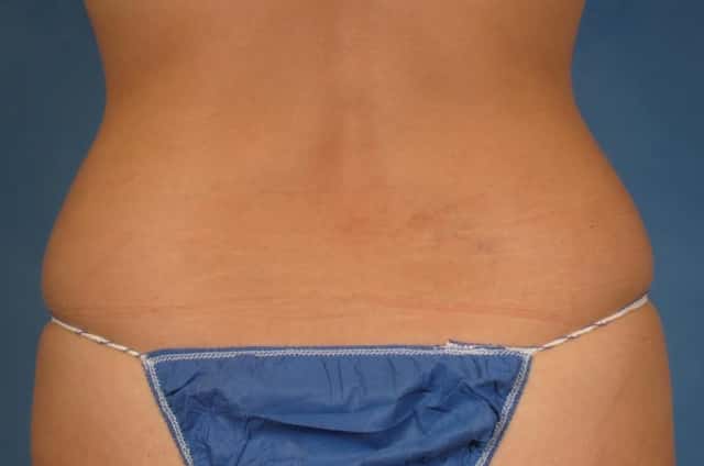 CoolSculpting Elite Before & After Case 215 before