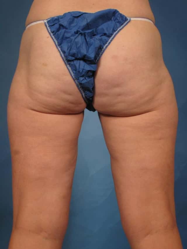 CoolSculpting Elite Before & After Case 222 after