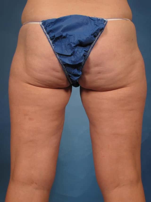 CoolSculpting Elite Before & After Case 222 before