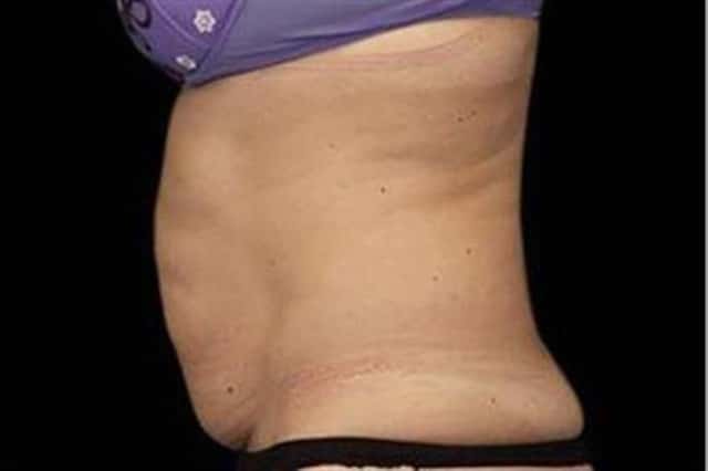 EMSCULPT NEO Before & After Case 345 before