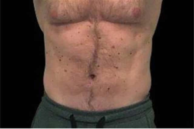 EMSCULPT NEO Before & After Case 346 after