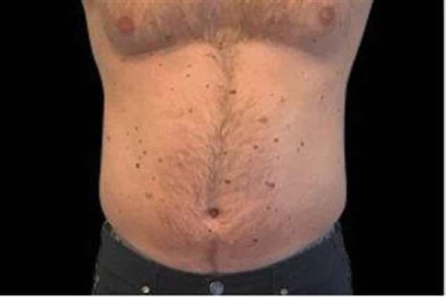 EMSCULPT NEO Before & After Case 346 before
