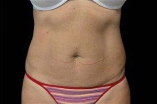 EMSCULPT NEO Before & After Case 347 after