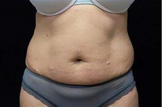 EMSCULPT NEO Before & After Case 347 before