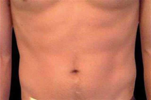EMSCULPT NEO Before & After Case 348 after