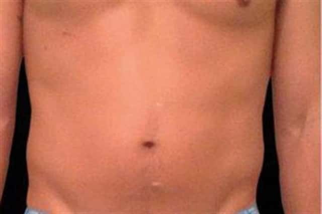 EMSCULPT NEO Before & After Case 348 before