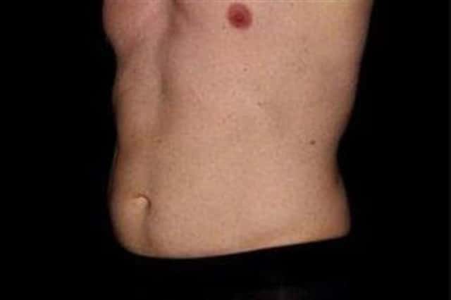 EMSCULPT NEO Before & After Case 349 before