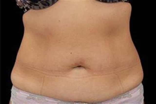 EMSCULPT NEO Before & After Case 350 after